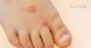 Gatal gigitan serangga