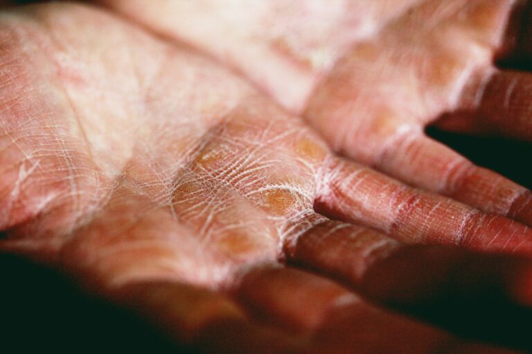 - Atasi Gatal Kulit dengan Tanaman Herbal person holding brown and white textile